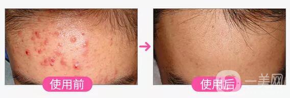 彩光祛痘印前后 彩光祛痘*果怎么樣 會(huì)復(fù)發(fā)嗎？	