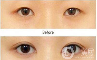 割雙眼皮術(shù)后護(hù)理 雙眼皮手術(shù)方法