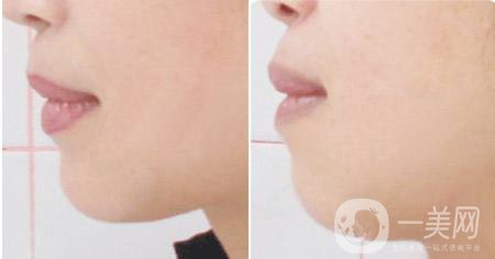 面部光纖溶脂會(huì)反彈嗎 有副作用嗎