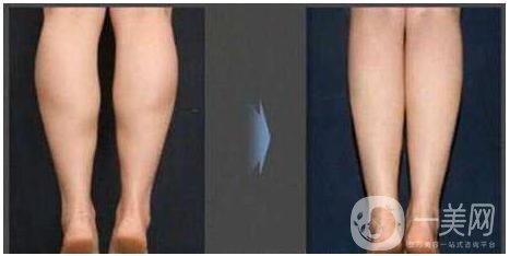瘦小腿有什么*的好方法？
