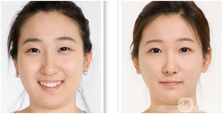 什么是雙下巴手術(shù)？術(shù)前需要準(zhǔn)備什么？