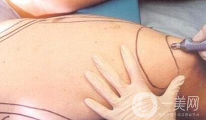 【科普】吸脂減肥常見的并發(fā)癥有哪些？怎么樣*避免呢？