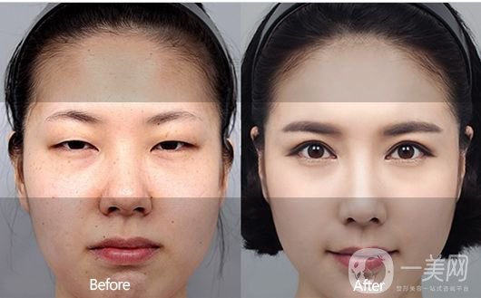 一般割雙眼皮多少錢？影響價(jià)格的因素有哪些？