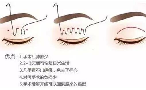 做埋線雙眼皮術(shù)后多久恢復(fù) 注意事項是什么