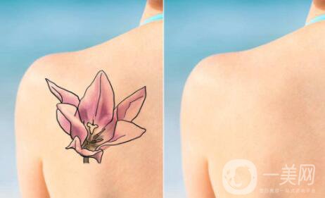 激光洗紋身*果圖 激光洗紋身會留疤嗎