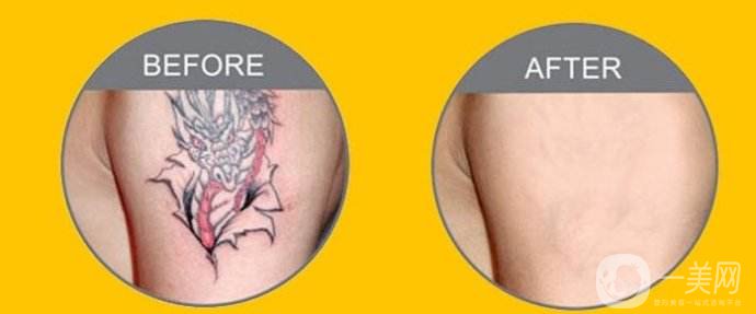 激光洗紋身*果圖 激光洗紋身會留疤嗎