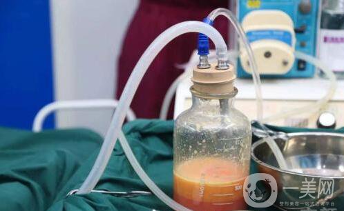 “吸脂減肥"手術(shù)前，你需要知道這些小常識(shí) 