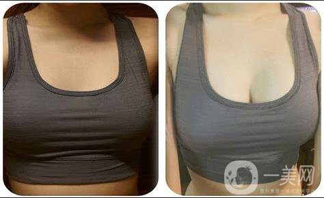 隆胸手術(shù)后應(yīng)該注意什么？如何護(hù)理？