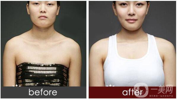 假體隆胸材料圓形和水滴形有什么區(qū)別？