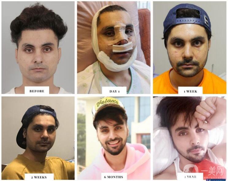 面部輪廓手術(shù)的恢復時間及注意事項講解