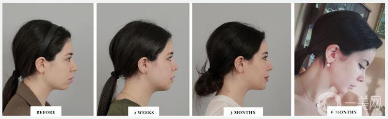 面部輪廓手術(shù)的恢復時間及注意事項講解
