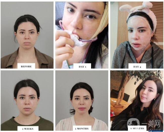 面部輪廓手術(shù)的恢復時間及注意事項講解