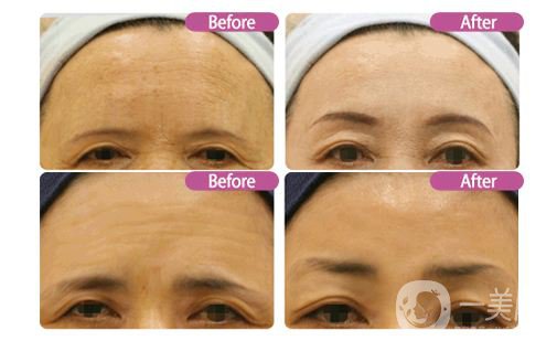 注射伊維蘭除皺后應(yīng)該要注意哪些問(wèn)題呢?