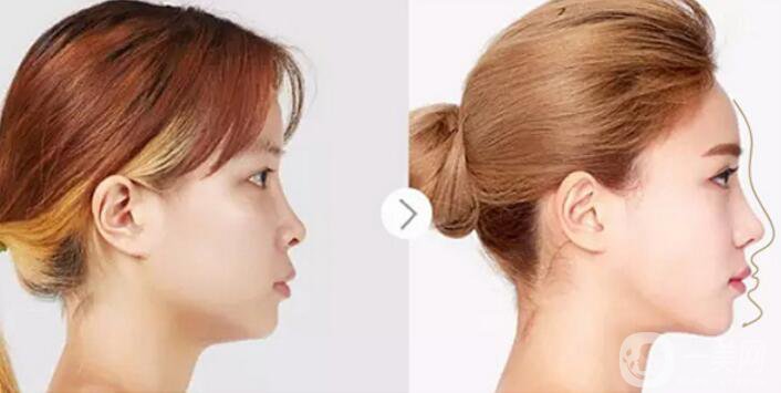 北京自體脂肪隆鼻多少錢