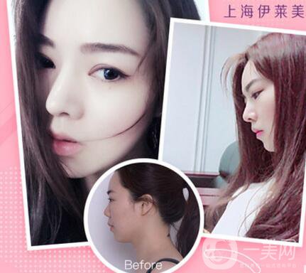 上海伊萊美口碑怎么樣？是正規(guī)醫(yī)院嗎？