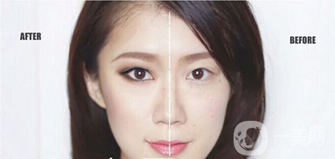 重慶做雙眼皮要多少錢 割雙眼皮喲風險嗎