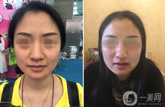 到底哪種面部提升手術(shù)適合你？