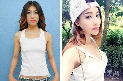 隆胸后出現(xiàn)哪些情況需要做修復(fù)？