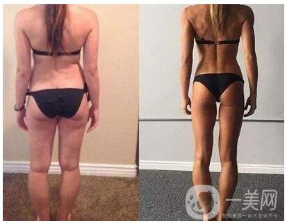 吸脂術后注意事項