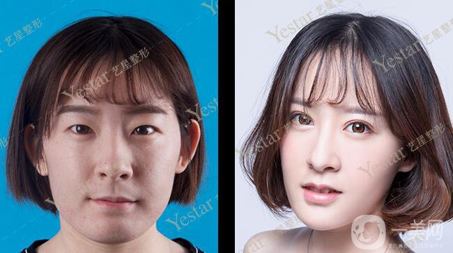 *前后 *手術(shù)*果如何？