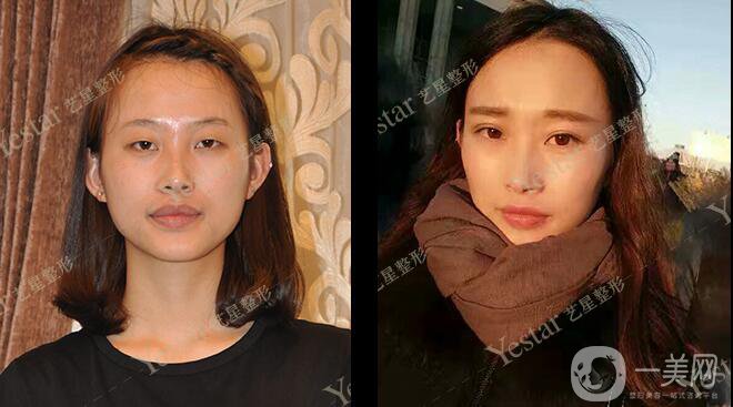 *前后 *手術(shù)*果如何？