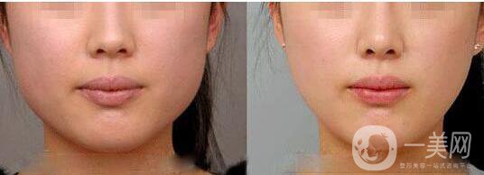 去頰脂墊手術(shù)*果怎么樣 去頰脂墊手術(shù)方法