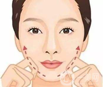 去頰脂墊手術(shù)*果怎么樣 去頰脂墊手術(shù)方法