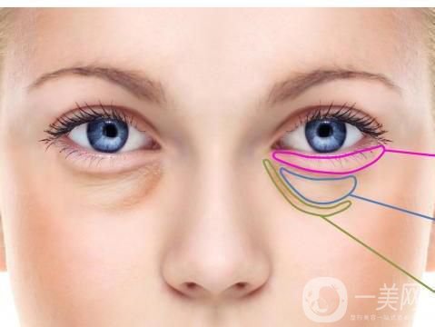 深圳去眼袋手術(shù)多少錢(qián) 去眼袋有什么風(fēng)險(xiǎn)嗎？