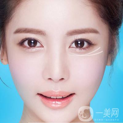 深圳去眼袋手術(shù)多少錢(qián) 去眼袋有什么風(fēng)險(xiǎn)嗎？