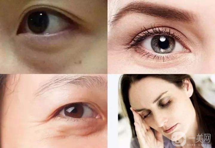 深圳去眼袋手術(shù)多少錢(qián) 去眼袋有什么風(fēng)險(xiǎn)嗎？