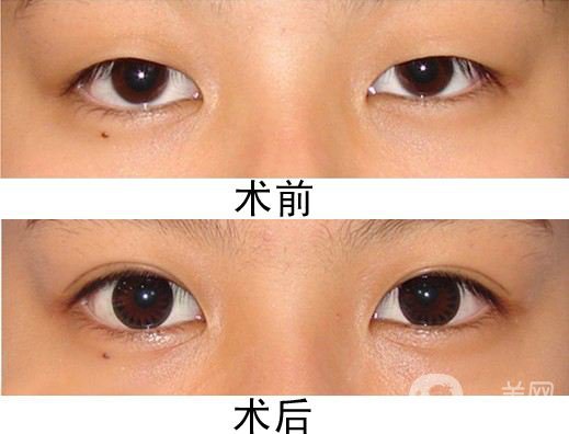 割雙眼皮多久后熱敷 割雙眼皮多久可以化妝