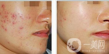 微針美容費(fèi)用,微針美容貴不貴
