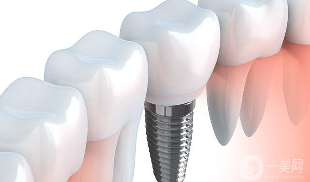 深圳種植牙價(jià)格,深圳種植牙多少錢(qián)