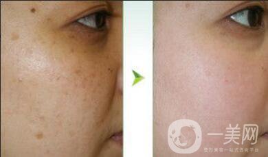 紅寶石激光祛斑*果,紅寶石激光祛斑術(shù)后注意事項