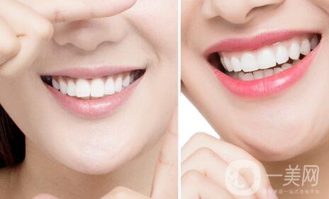 哪種烤瓷牙比較好？他們有什么區(qū)別呢？