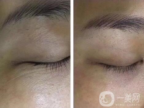 醫(yī)院調(diào)節(jié)魚(yú)尾紋案例