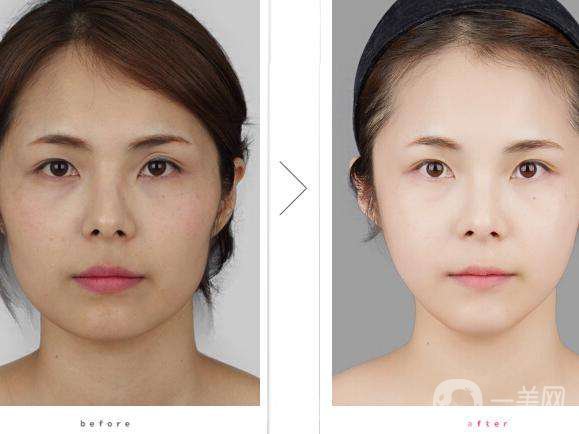 光子嫩膚做一次多少錢(qián) 光子嫩膚可以除皺嗎