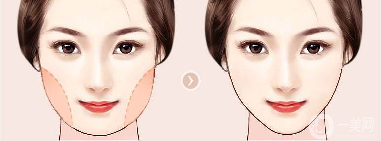 面部吸脂減肥價(jià)格 面部吸脂多久消腫