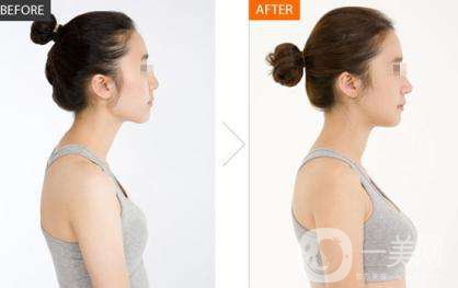 假體隆胸的價格是多少 假體隆胸能保持多久