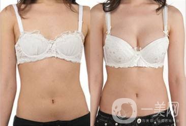 沃斯堡豐胸術(shù)怎么樣 隆胸的風(fēng)險有多大？