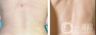 后背溶脂方法,后背溶脂多少錢