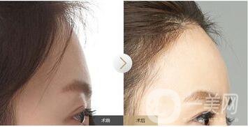 玻尿酸額頭一般打幾針