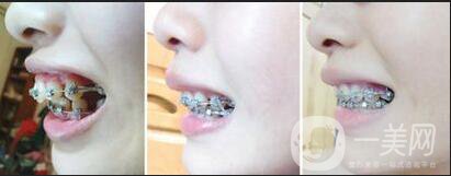天包地牙齒矯正,天包地牙齒矯正手術方法