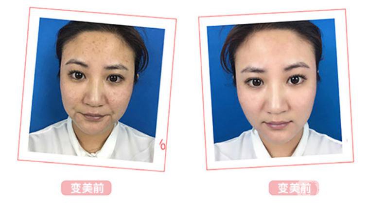 光子嫩膚*果介紹？對皮膚會有傷害嗎？