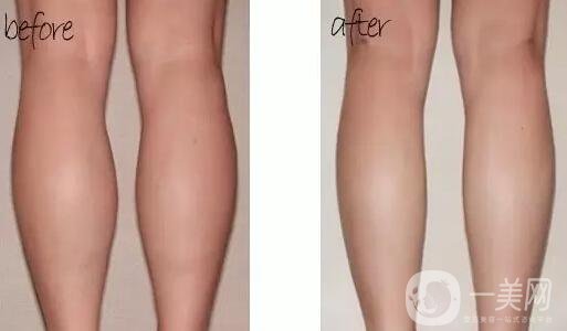 **多少錢 有副作用嗎 需要注射幾次？