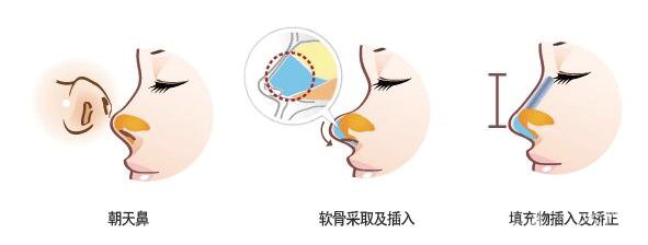 朝天鼻矯正多久能恢復(fù) 朝天鼻矯正前后