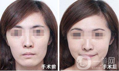 臉頰隆起的原因是什么 手術(shù)怎么做？