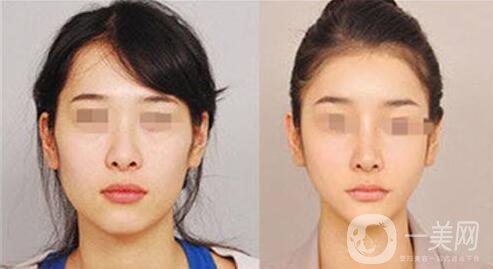 下頜整形手術(shù)的方法有哪些？