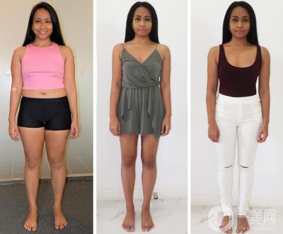 你真的適合吸脂手術(shù)嗎？吸脂適應癥介紹