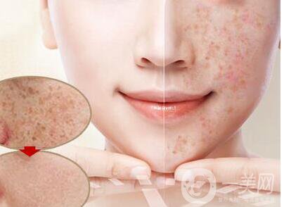 激光去曬斑多久恢復(fù),激光去曬斑術(shù)后護(hù)理